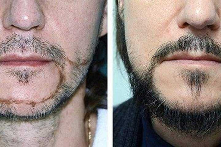 Почему растут щеки. Растительность на лице у мужчин. Редкая растительность на лице. Редкая борода. Формы растительности на лице.